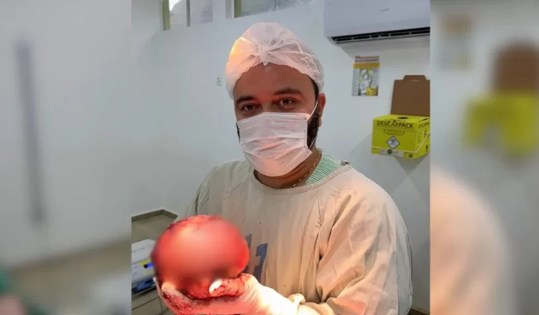 Médico mostra extração de tumor gigante de quase 2 kg: ‘Um recorde’